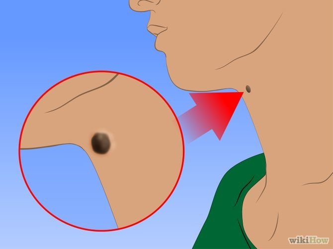 Remove-Moles-