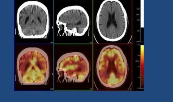 Neurological Disorders Responsible For 11 Million Deaths Each Year Globally: WHO